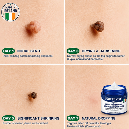 Natravor® 7-𝐃𝐚𝐲 𝐒𝐤𝐢𝐧 𝐓𝐚𝐠 & 𝐒𝐩𝐨𝐭 𝐄𝐫𝐚𝐬𝐞𝐫 𝐂𝐫𝐞𝐚𝐦 (Zero Pain, Zero 𝐒𝐜𝐚𝐫𝐬 Formula) 💎