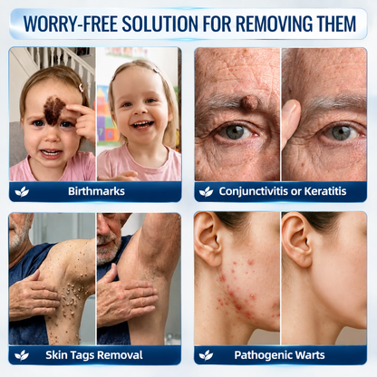 Natravor® 7-𝐃𝐚𝐲 𝐒𝐤𝐢𝐧 𝐓𝐚𝐠 & 𝐒𝐩𝐨𝐭 𝐄𝐫𝐚𝐬𝐞𝐫 𝐂𝐫𝐞𝐚𝐦 (Zero Pain, Zero 𝐒𝐜𝐚𝐫𝐬 Formula) 💎